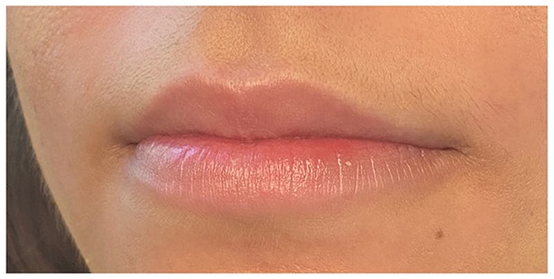 Lip Enhancement Before & After Gallery - Patient 133024162 - Image 3