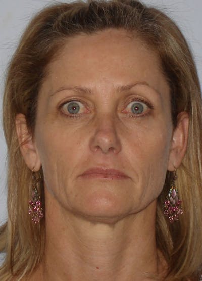 Facelift & Necklift Before & After Gallery - Patient 133024163 - Image 1