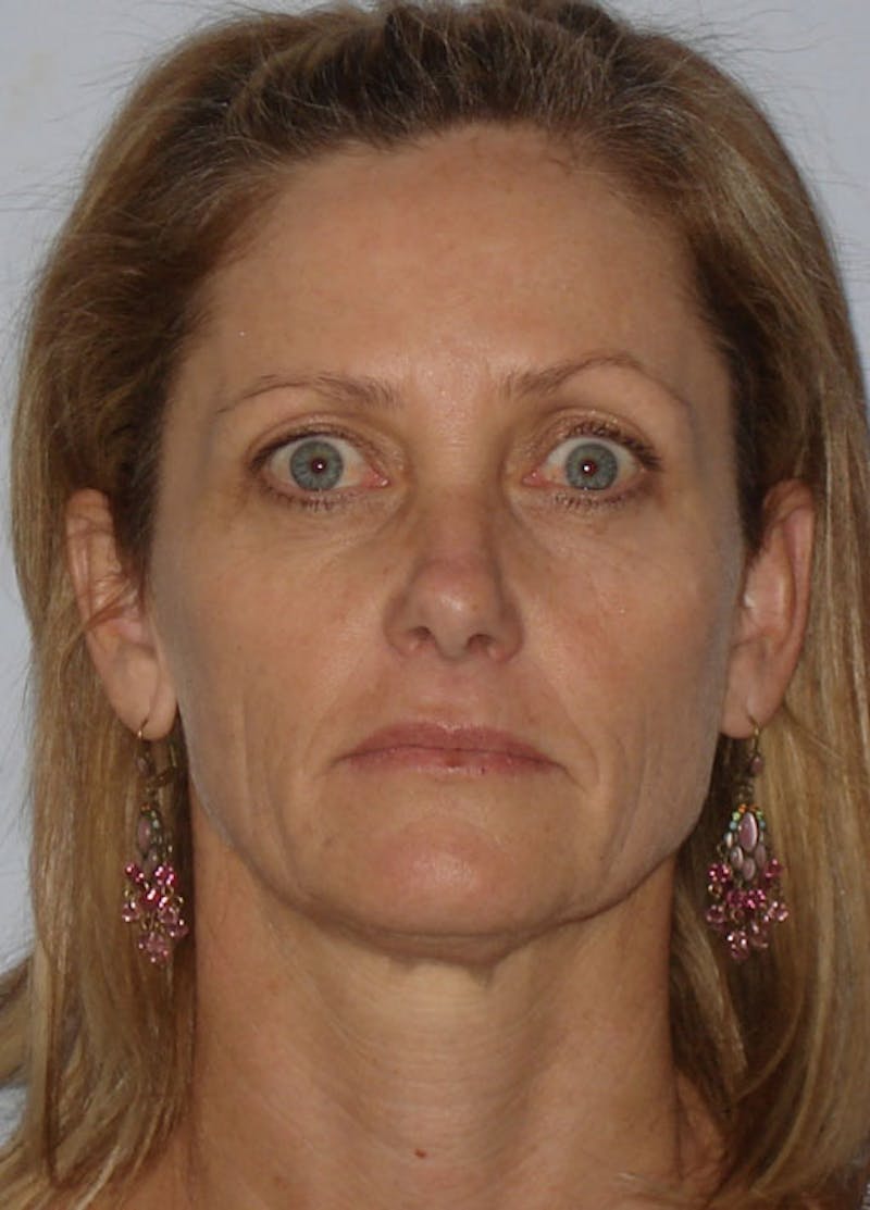 Facelift & Necklift Before & After Gallery - Patient 133024163 - Image 1