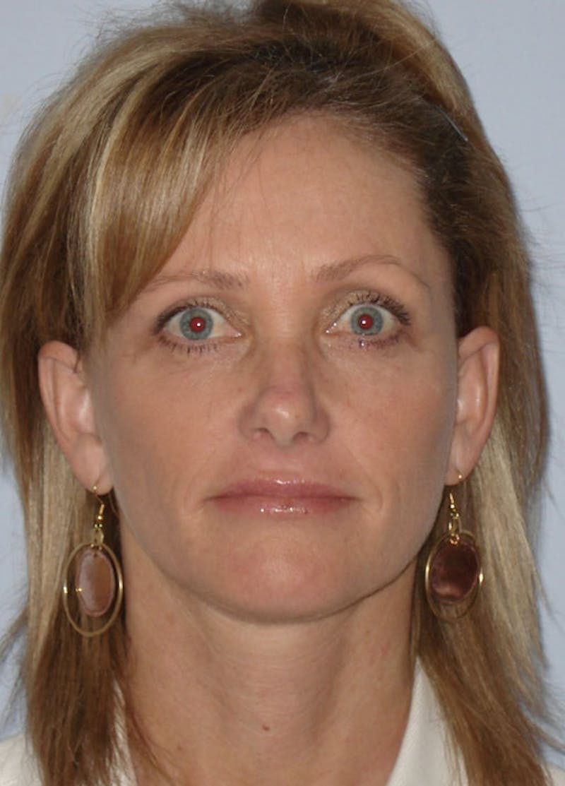 Facelift & Necklift Before & After Gallery - Patient 133024163 - Image 2