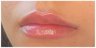 Lip Enhancement Before & After Gallery - Patient 133024162 - Image 4