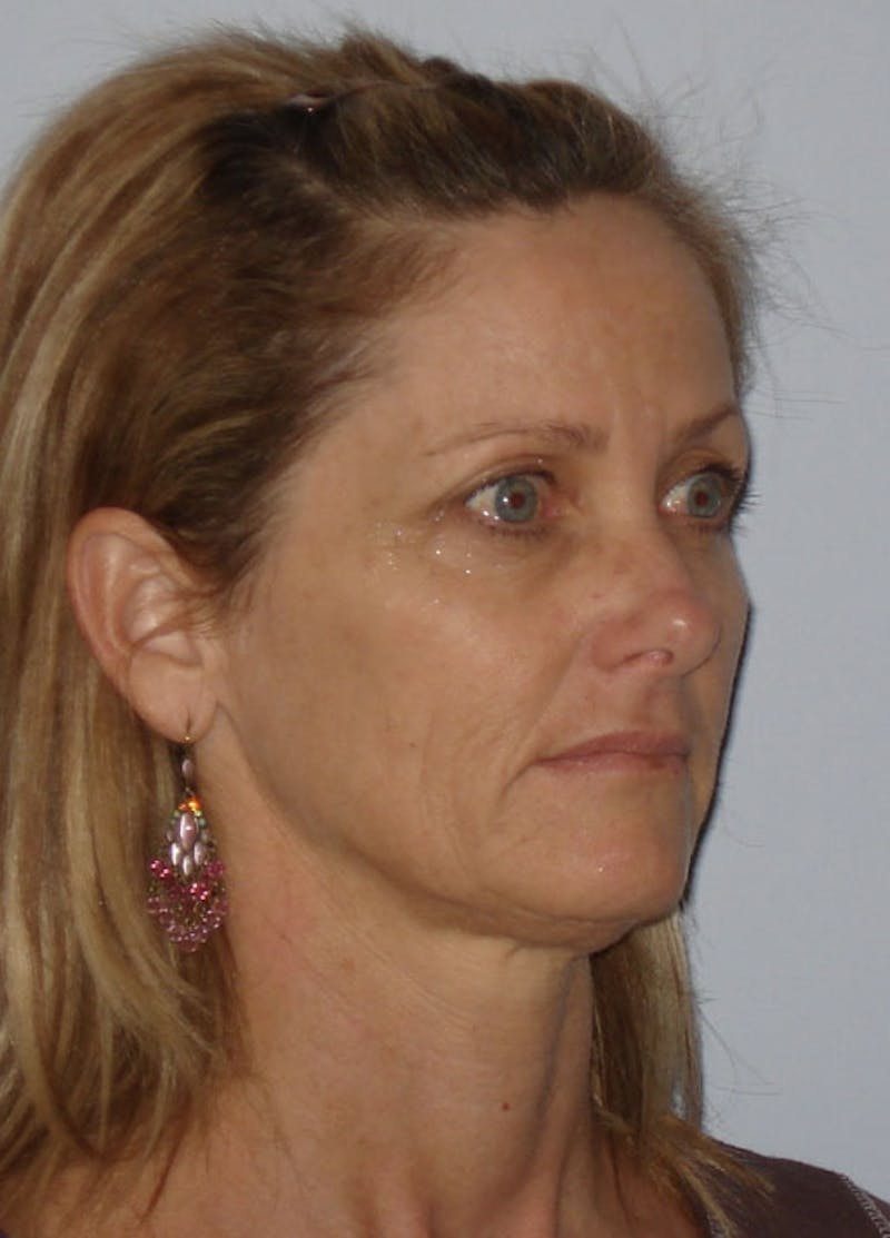 Facelift & Necklift Before & After Gallery - Patient 133024163 - Image 3