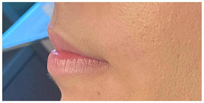 Lip Enhancement Before & After Gallery - Patient 133024162 - Image 5