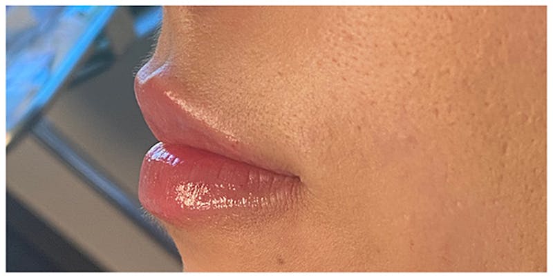 Lip Enhancement Before & After Gallery - Patient 133024162 - Image 6
