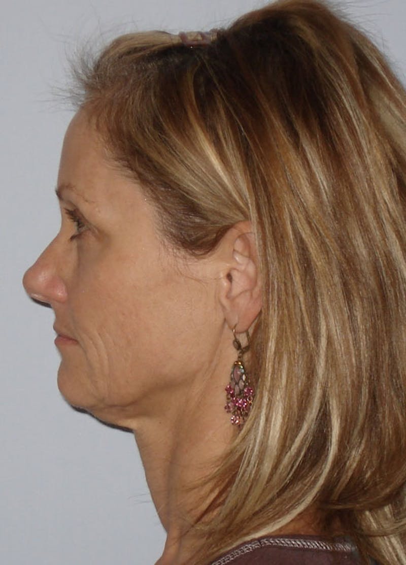 Facelift & Necklift Before & After Gallery - Patient 133024163 - Image 5