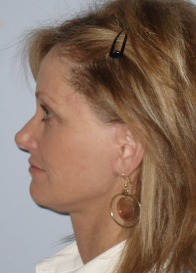 Facelift & Necklift Before & After Gallery - Patient 133024163 - Image 6