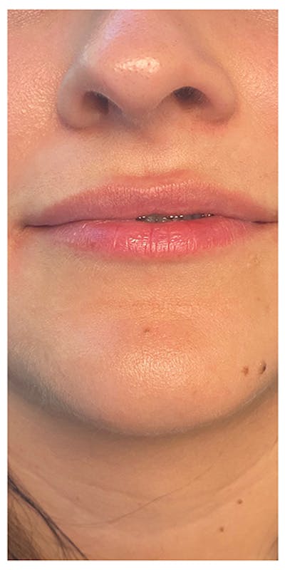 Lip Enhancement Before & After Gallery - Patient 133024166 - Image 1