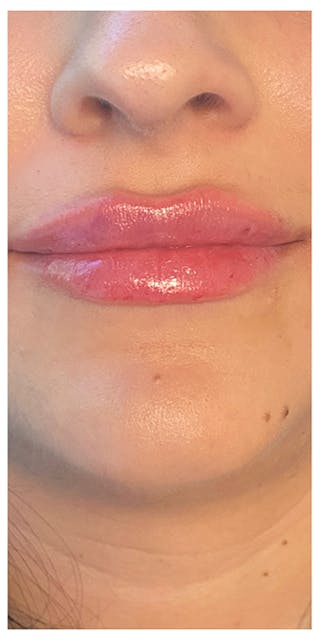 Lip Enhancement Before & After Gallery - Patient 133024166 - Image 2