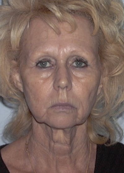 Facelift & Necklift Before & After Gallery - Patient 133024164 - Image 1