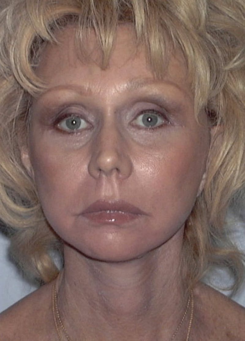 Facelift & Necklift Before & After Gallery - Patient 133024164 - Image 2