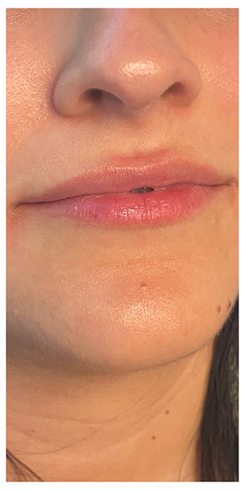 Lip Enhancement Before & After Gallery - Patient 133024166 - Image 3