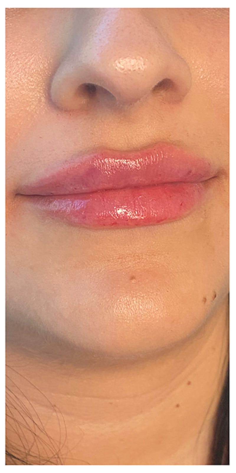 Lip Enhancement Before & After Gallery - Patient 133024166 - Image 4