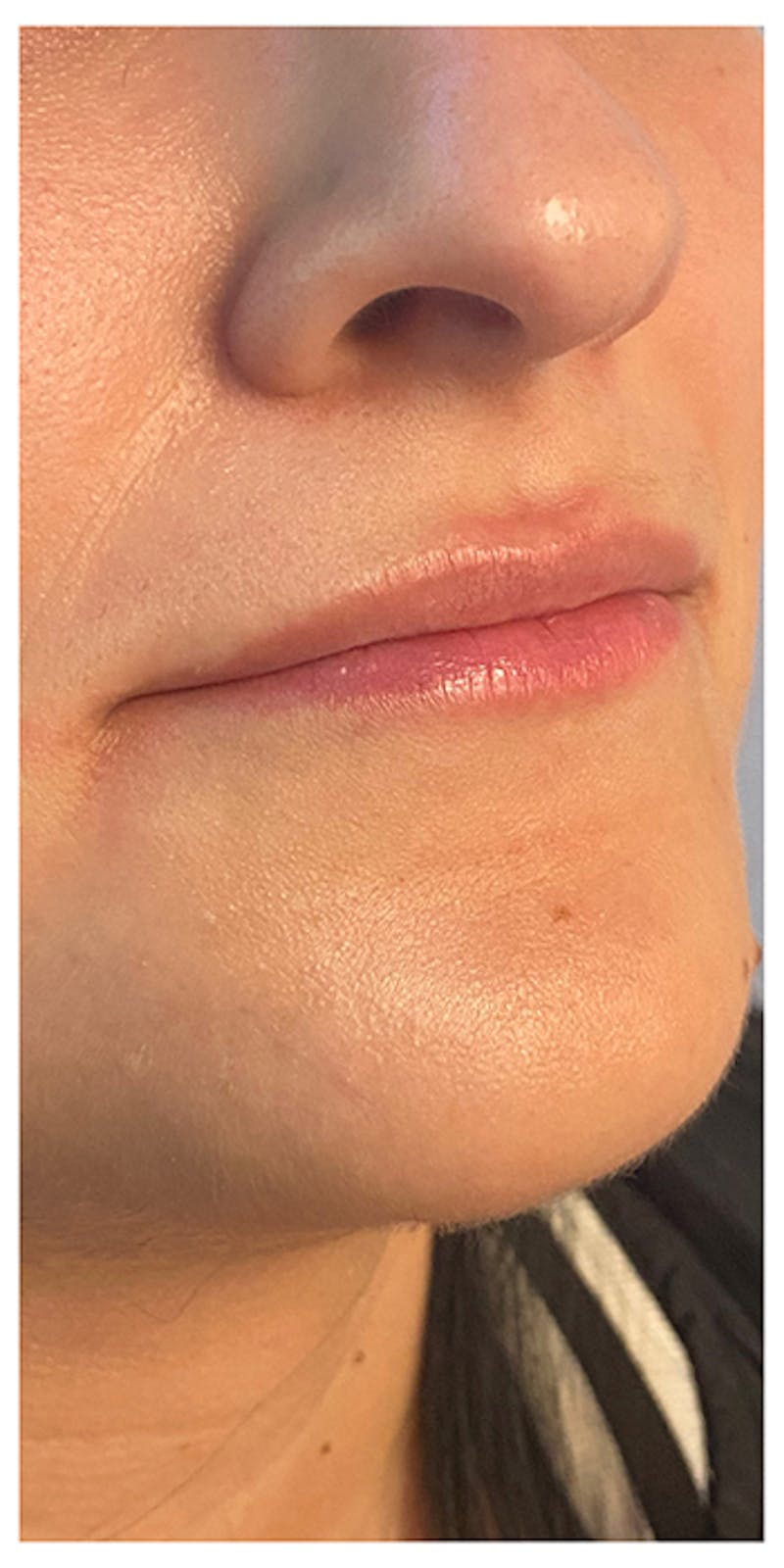 Lip Enhancement Before & After Gallery - Patient 133024166 - Image 5