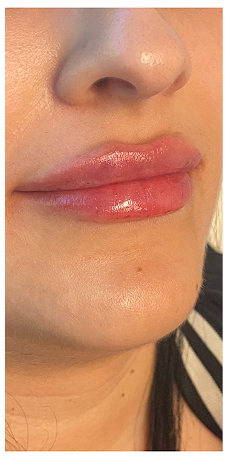 Lip Enhancement Before & After Gallery - Patient 133024166 - Image 6