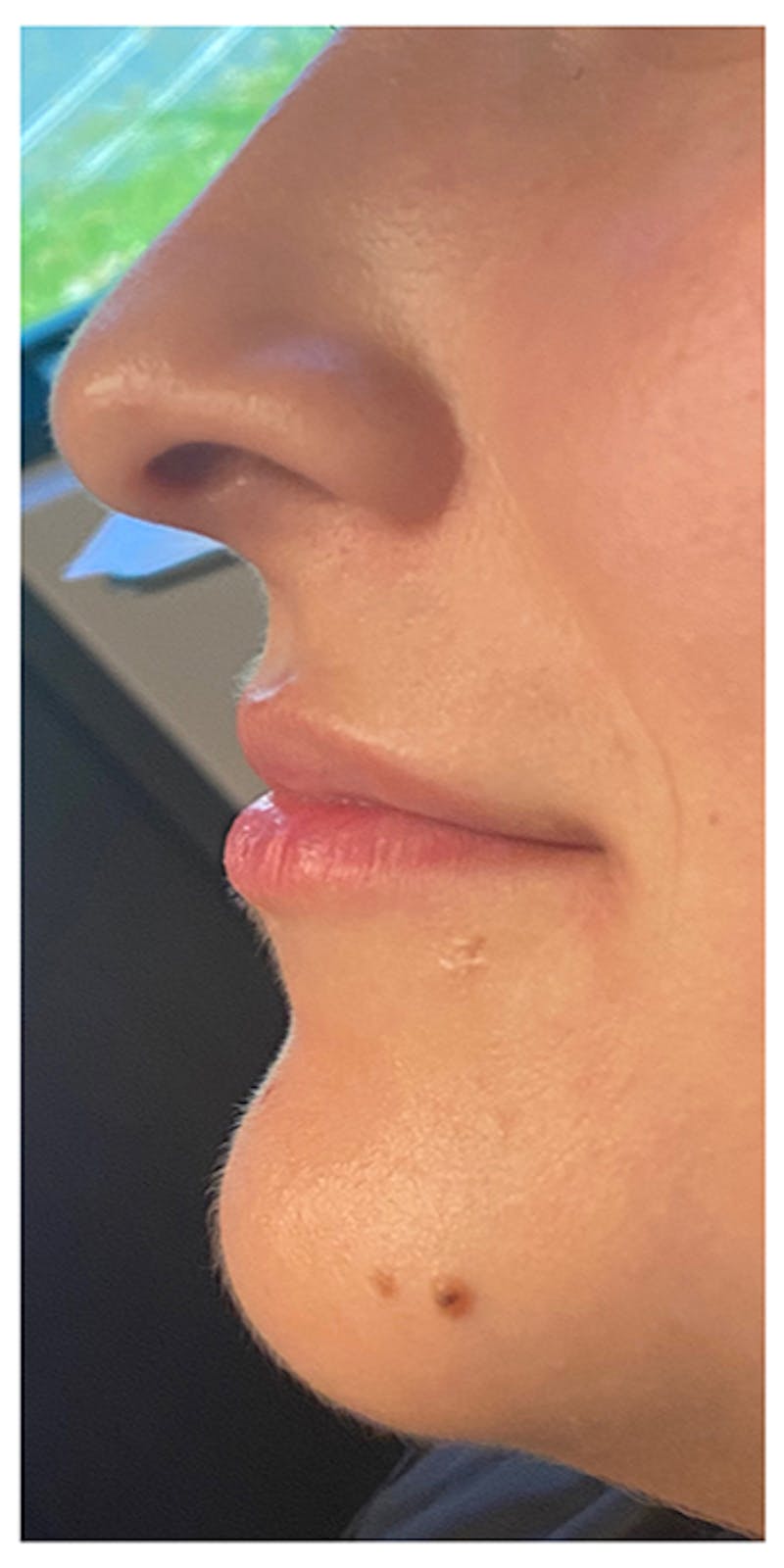 Lip Enhancement Before & After Gallery - Patient 133024166 - Image 7