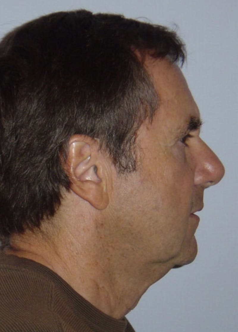 Facelift & Necklift Before & After Gallery - Patient 133024167 - Image 3