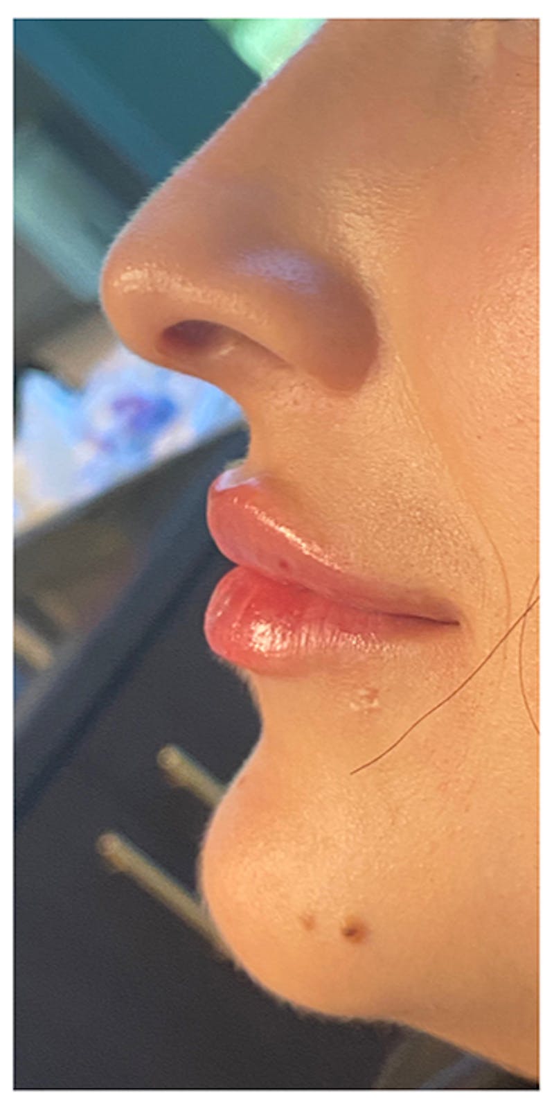 Lip Enhancement Before & After Gallery - Patient 133024166 - Image 8