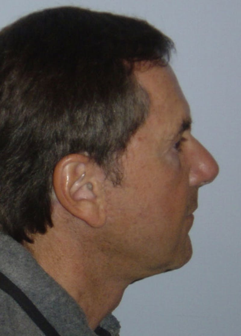 Facelift & Necklift Before & After Gallery - Patient 133024167 - Image 4