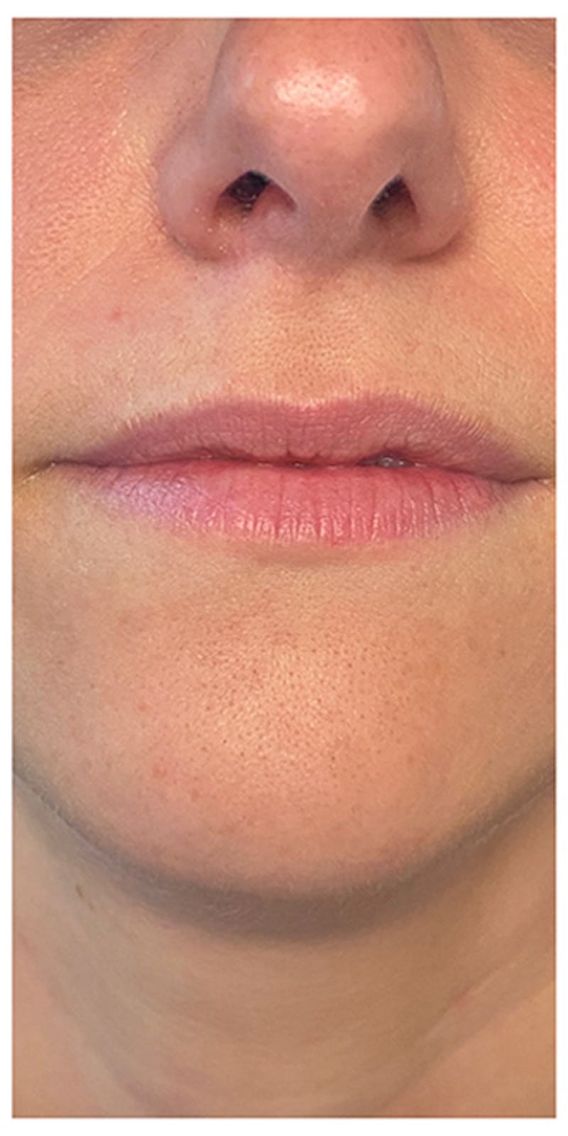 Lip Enhancement Before & After Gallery - Patient 133024169 - Image 1