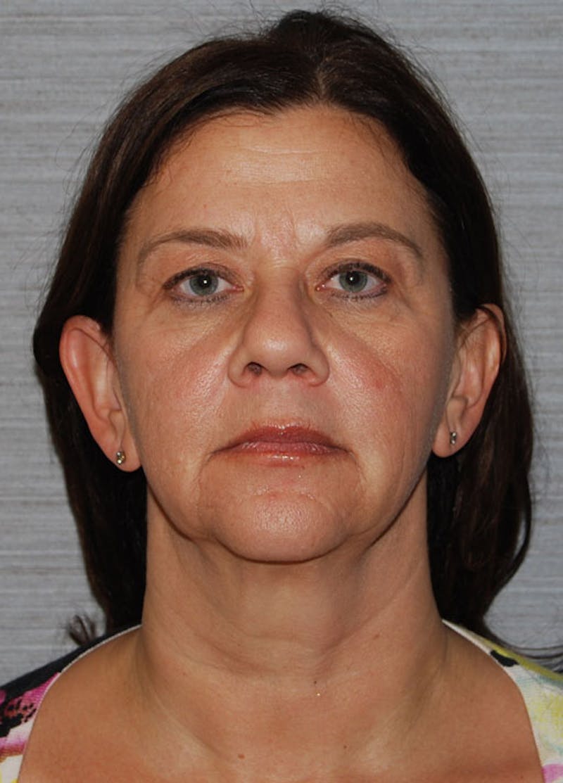 Facelift & Necklift Before & After Gallery - Patient 133024168 - Image 1