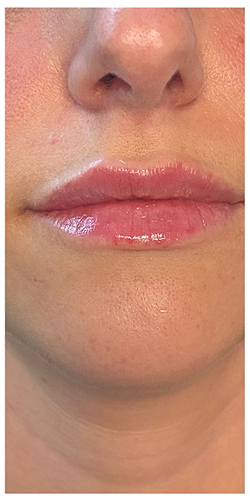 Lip Enhancement Before & After Gallery - Patient 133024169 - Image 2