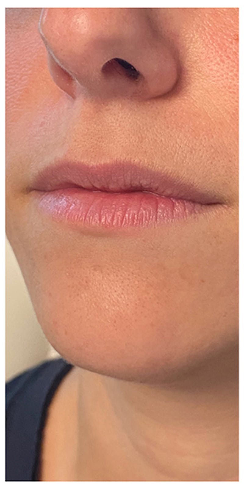 Lip Enhancement Before & After Gallery - Patient 133024169 - Image 3