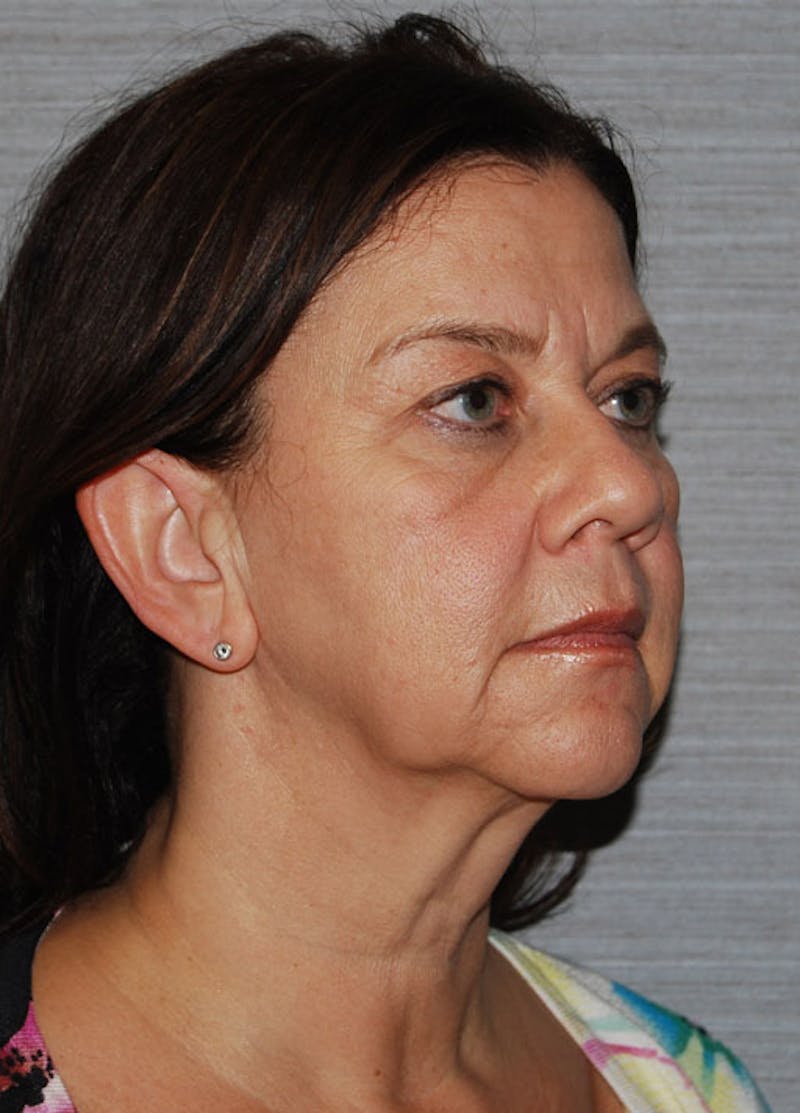 Facelift & Necklift Before & After Gallery - Patient 133024168 - Image 3