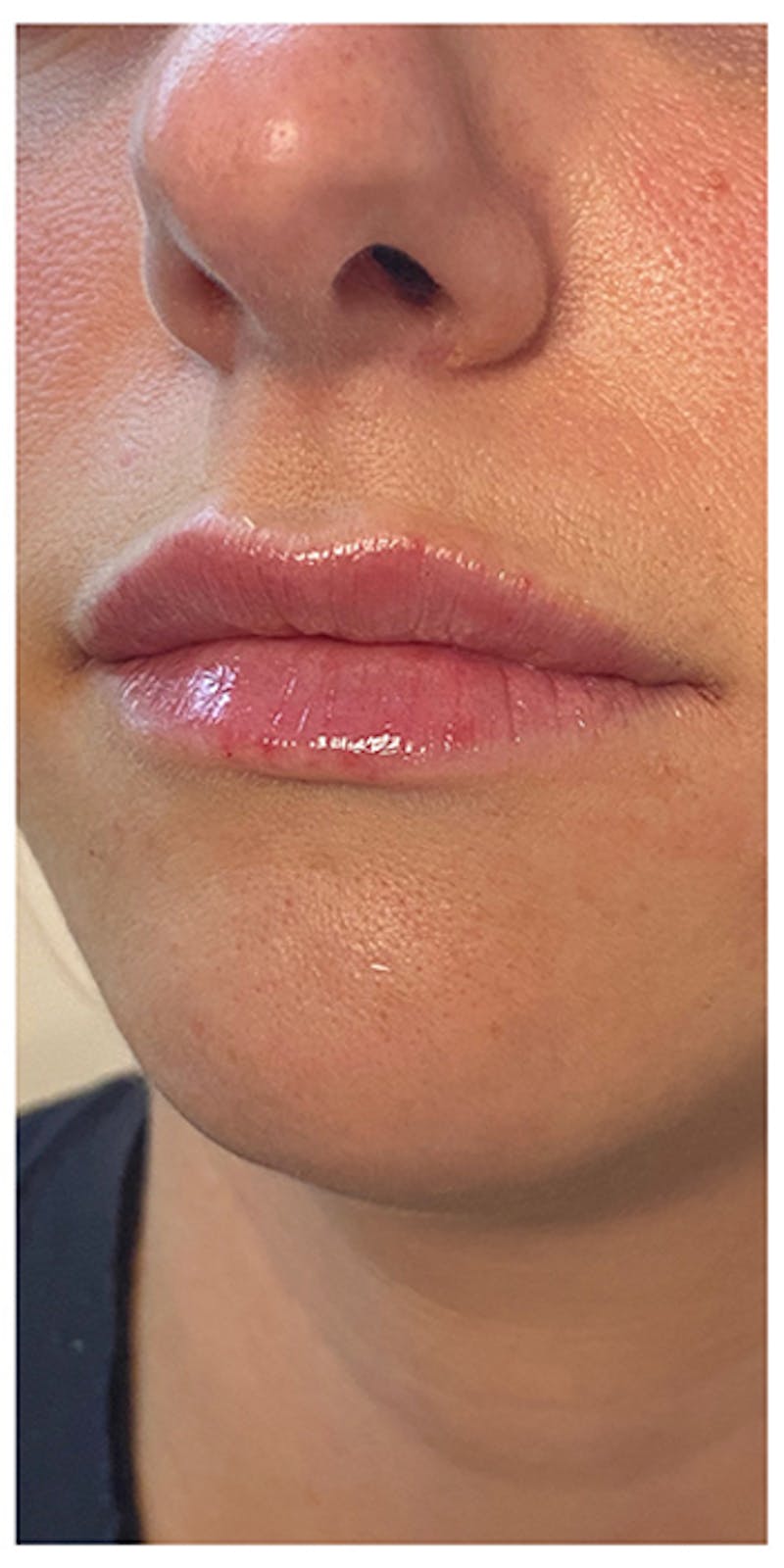 Lip Enhancement Before & After Gallery - Patient 133024169 - Image 4