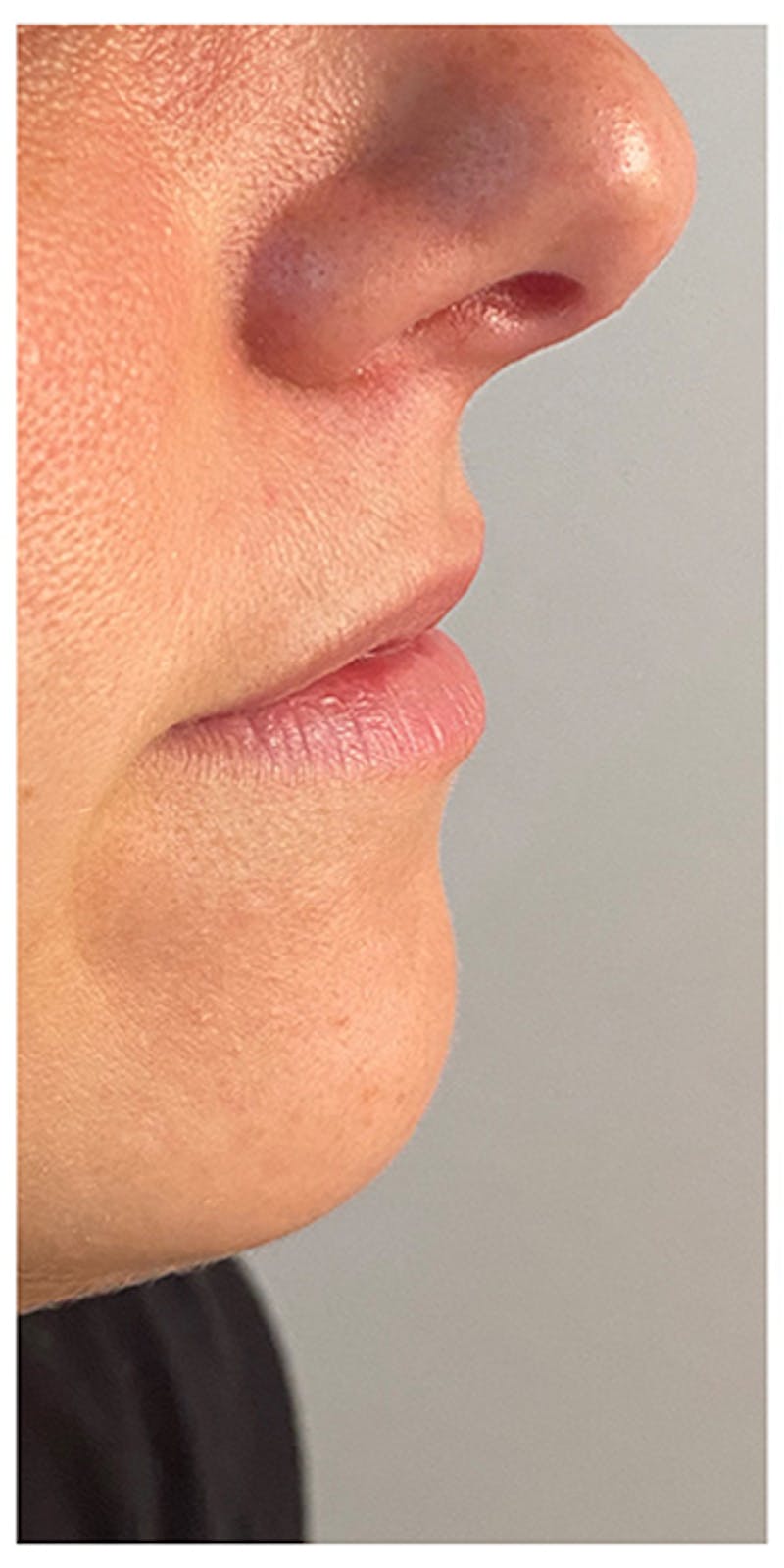 Lip Enhancement Before & After Gallery - Patient 133024169 - Image 5