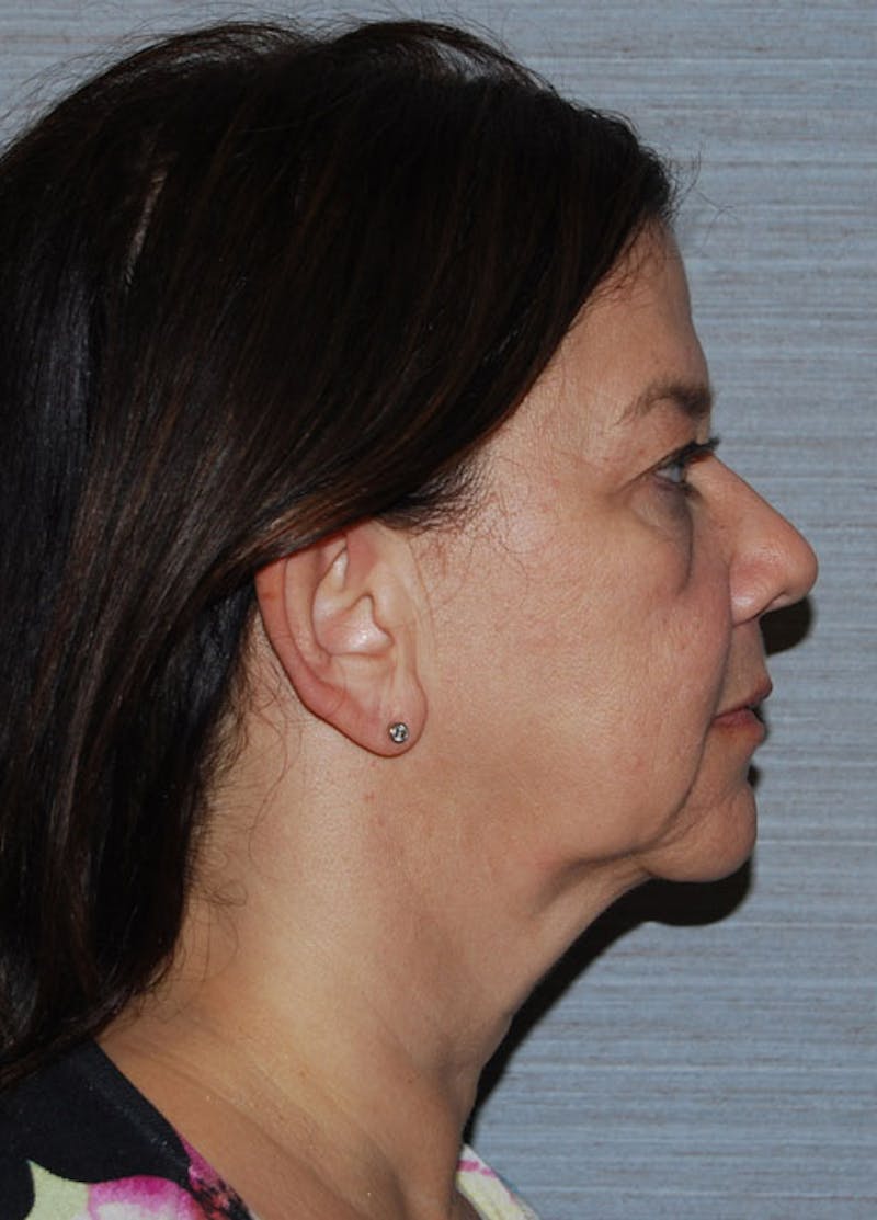 Facelift & Necklift Before & After Gallery - Patient 133024168 - Image 5