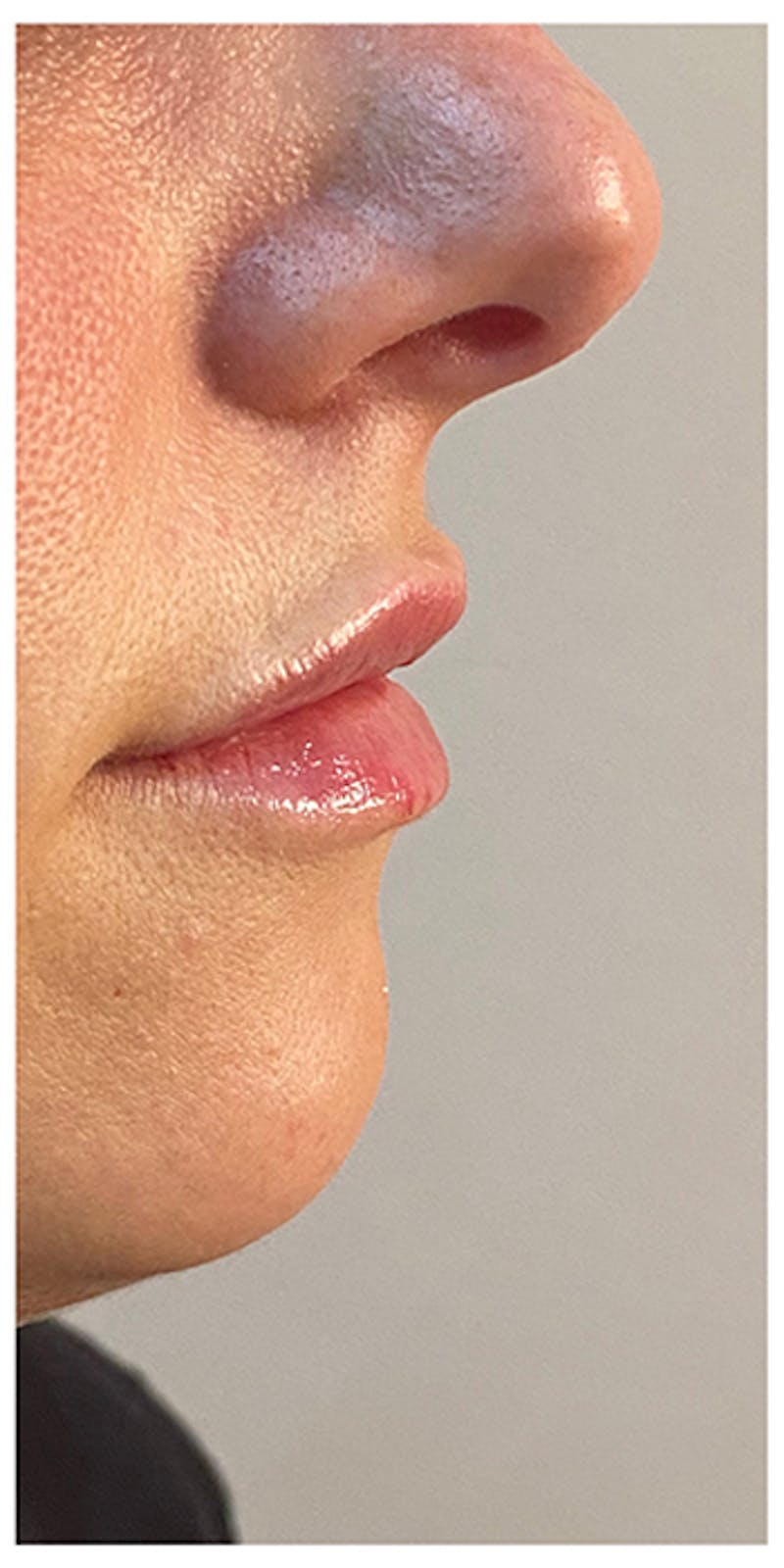 Lip Enhancement Before & After Gallery - Patient 133024169 - Image 6