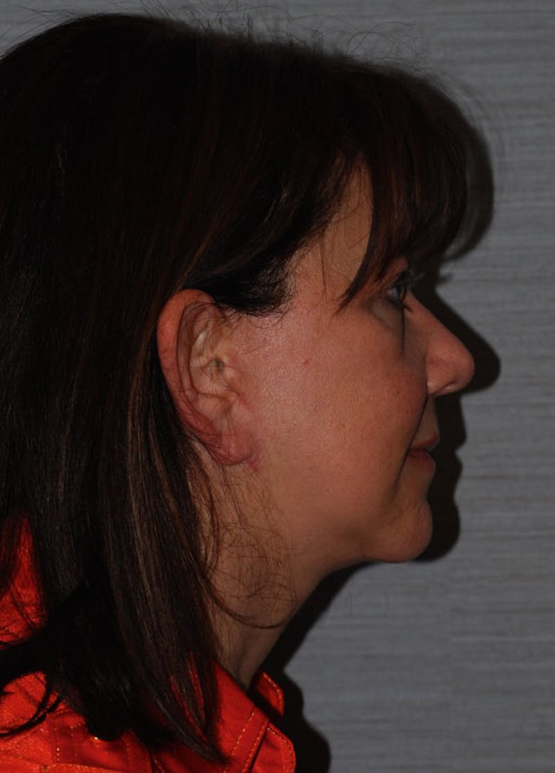 Facelift & Necklift Before & After Gallery - Patient 133024168 - Image 6