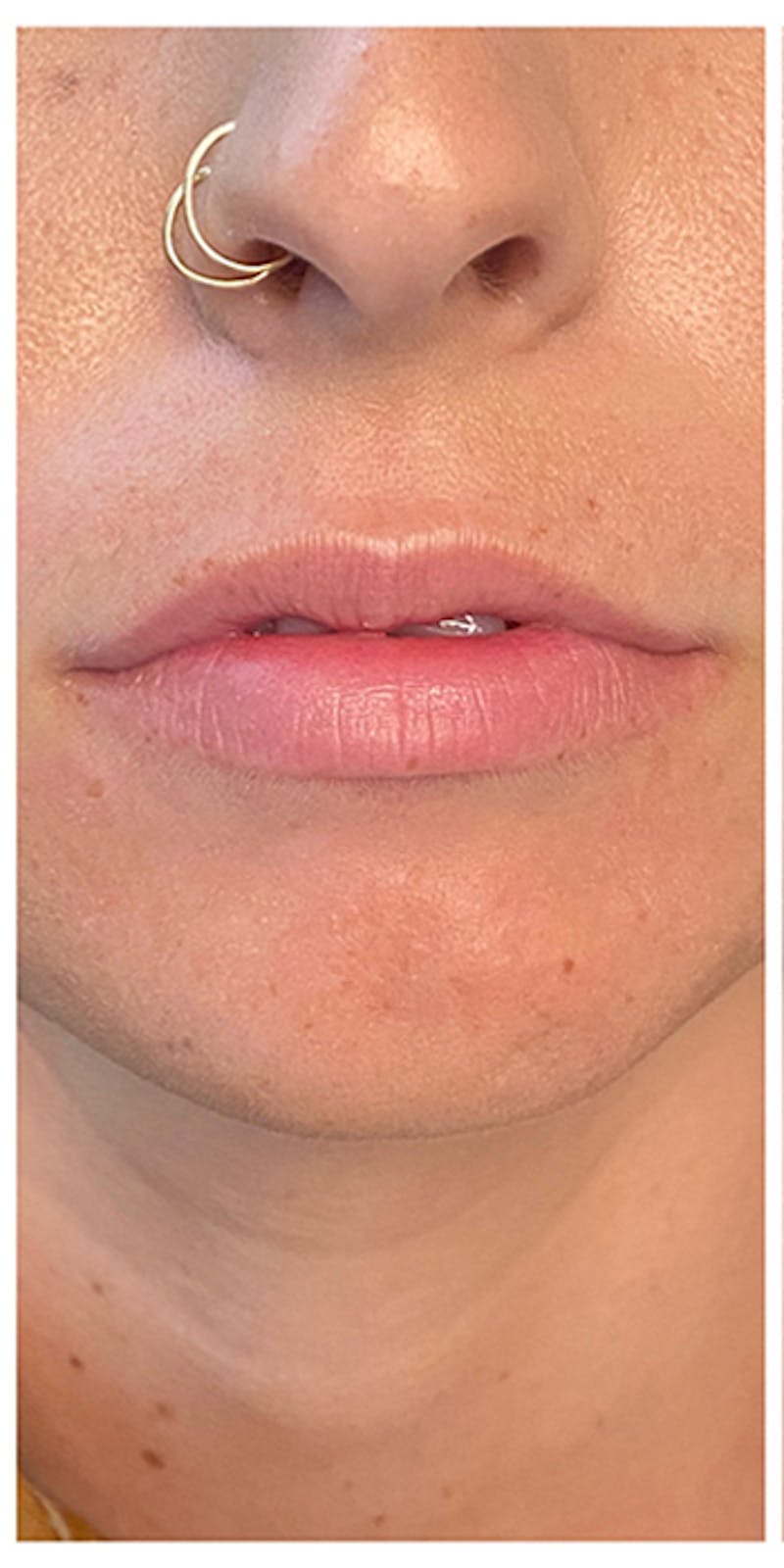 Lip Enhancement Before & After Gallery - Patient 133024177 - Image 1