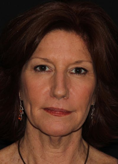 Facelift & Necklift Before & After Gallery - Patient 133024178 - Image 1