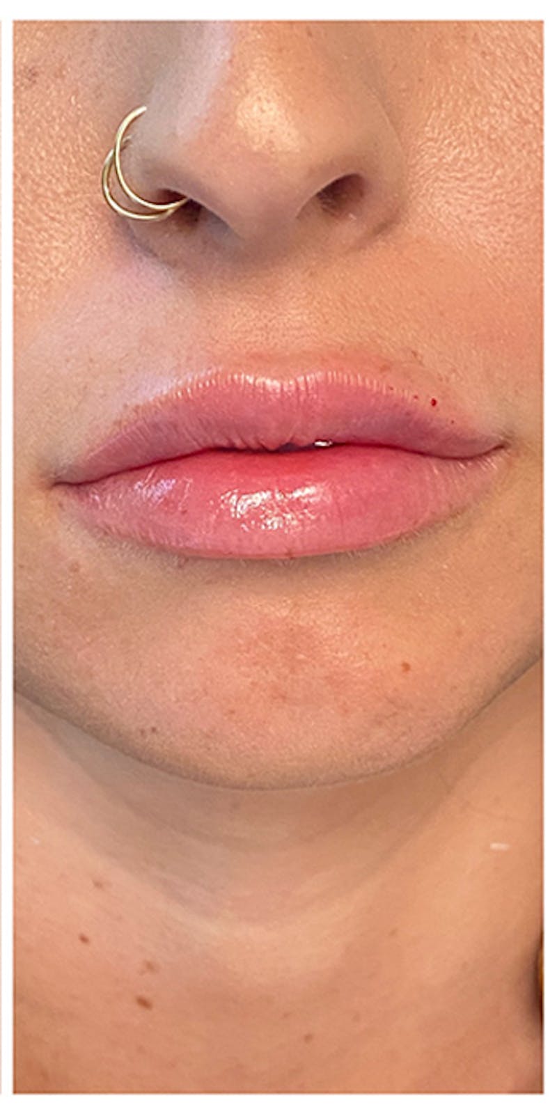 Lip Enhancement Before & After Gallery - Patient 133024177 - Image 2