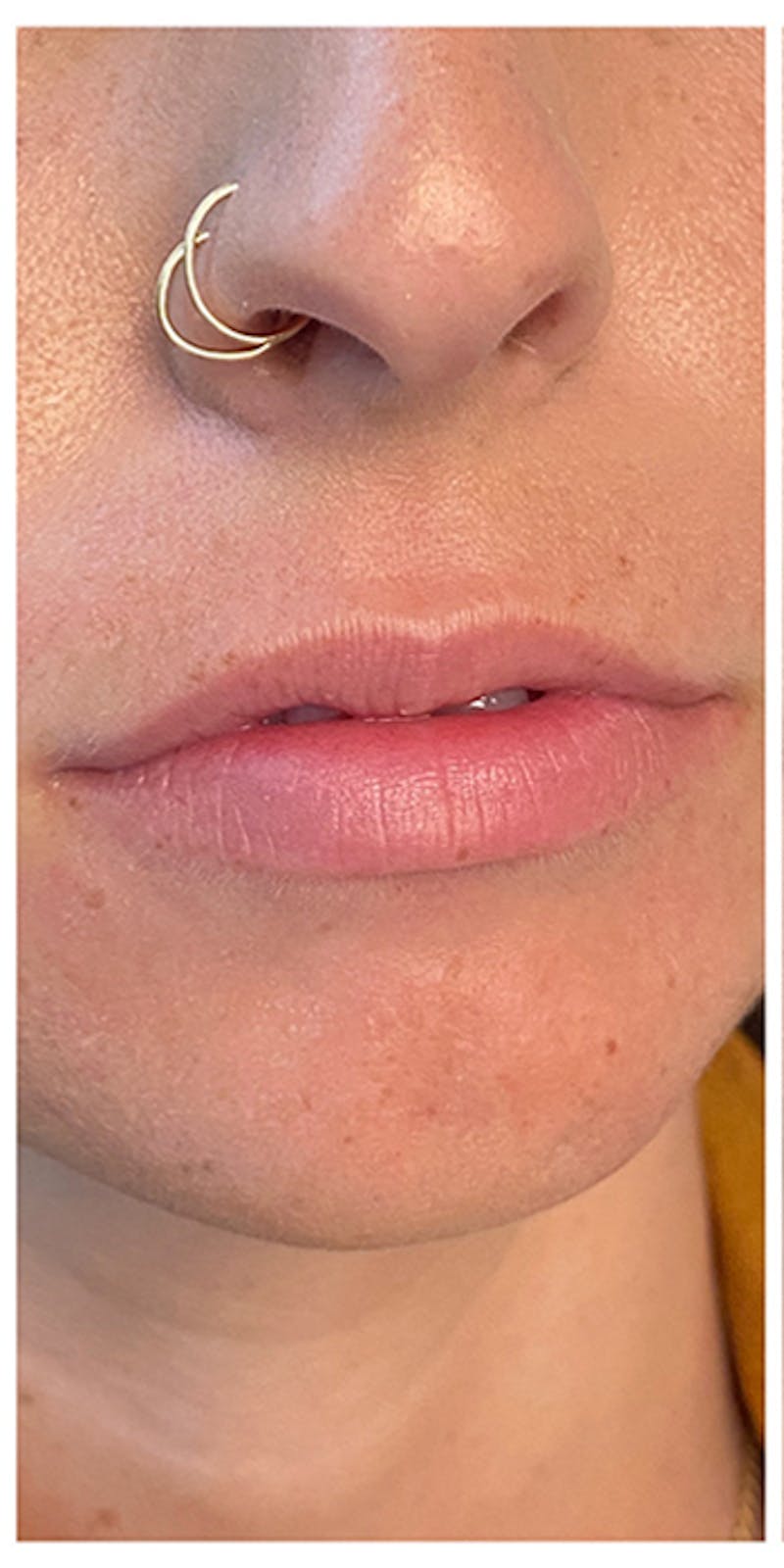 Lip Enhancement Before & After Gallery - Patient 133024177 - Image 3