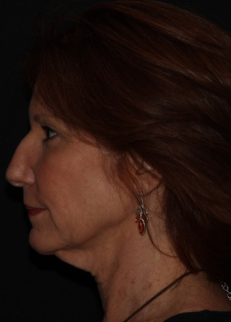 Facelift & Necklift Before & After Gallery - Patient 133024178 - Image 3