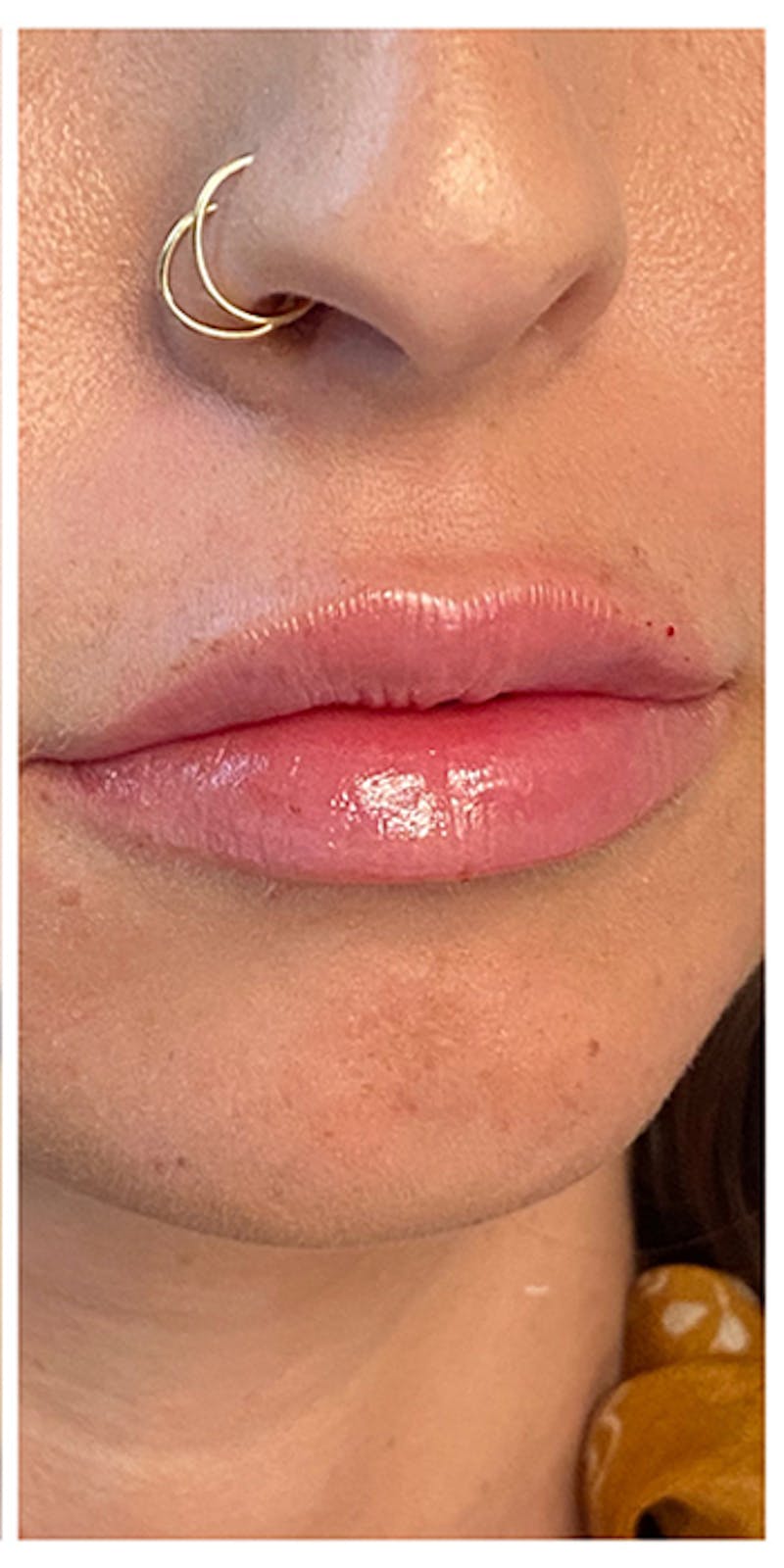 Lip Enhancement Before & After Gallery - Patient 133024177 - Image 4