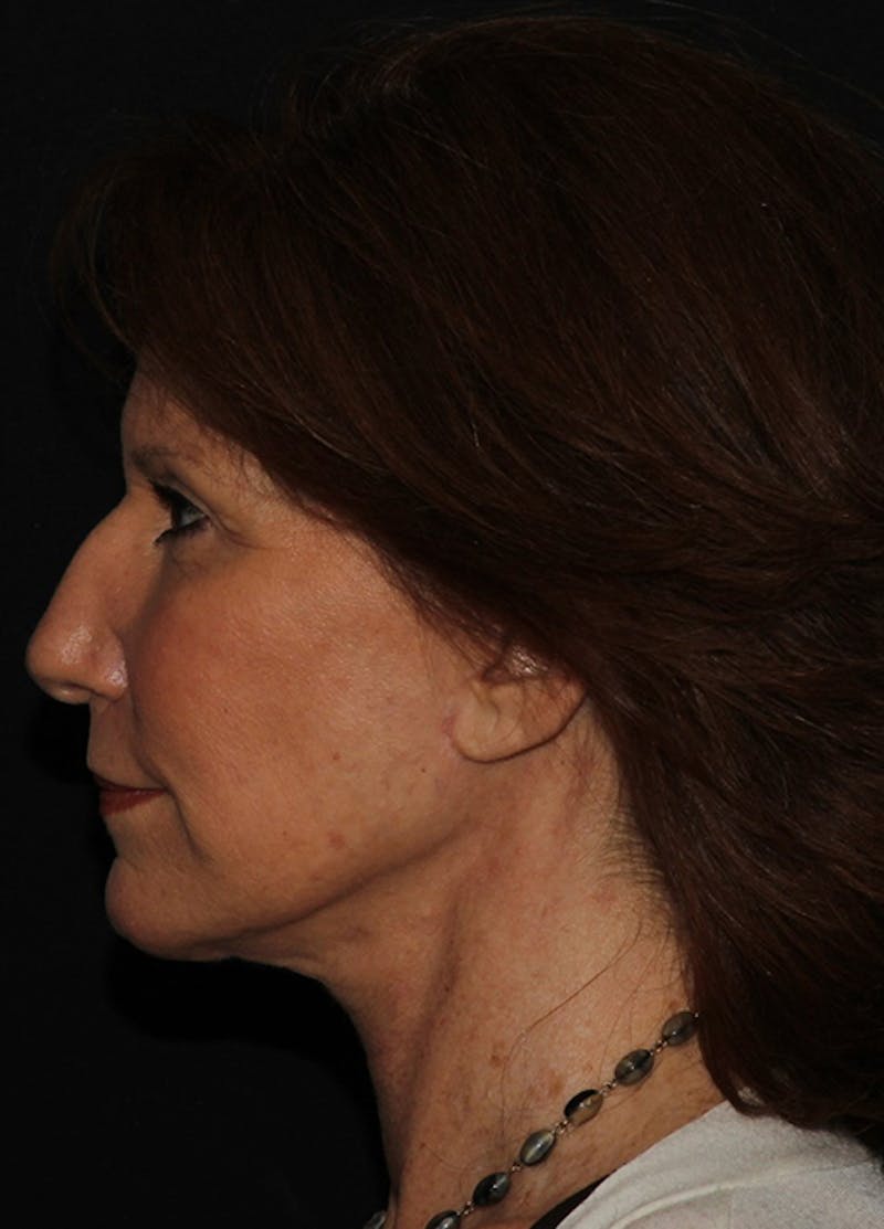 Facelift & Necklift Before & After Gallery - Patient 133024178 - Image 4