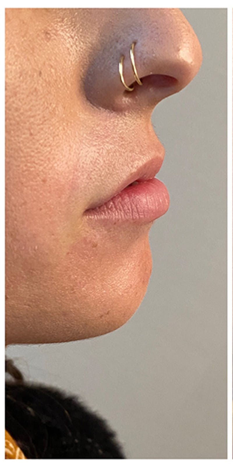 Lip Enhancement Before & After Gallery - Patient 133024177 - Image 5