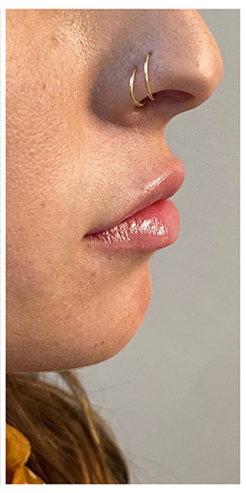 Lip Enhancement Before & After Gallery - Patient 133024177 - Image 6