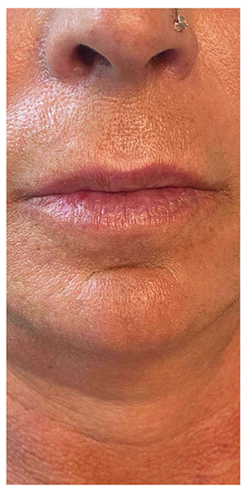 Lip Enhancement Before & After Gallery - Patient 133024185 - Image 1