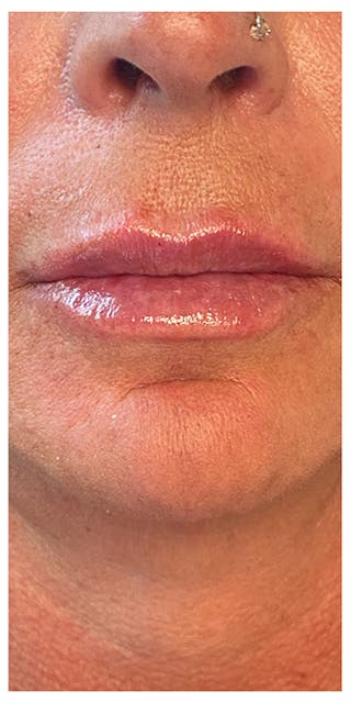 Lip Enhancement Before & After Gallery - Patient 133024185 - Image 2