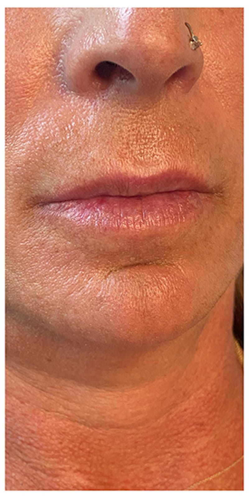 Lip Enhancement Before & After Gallery - Patient 133024185 - Image 3