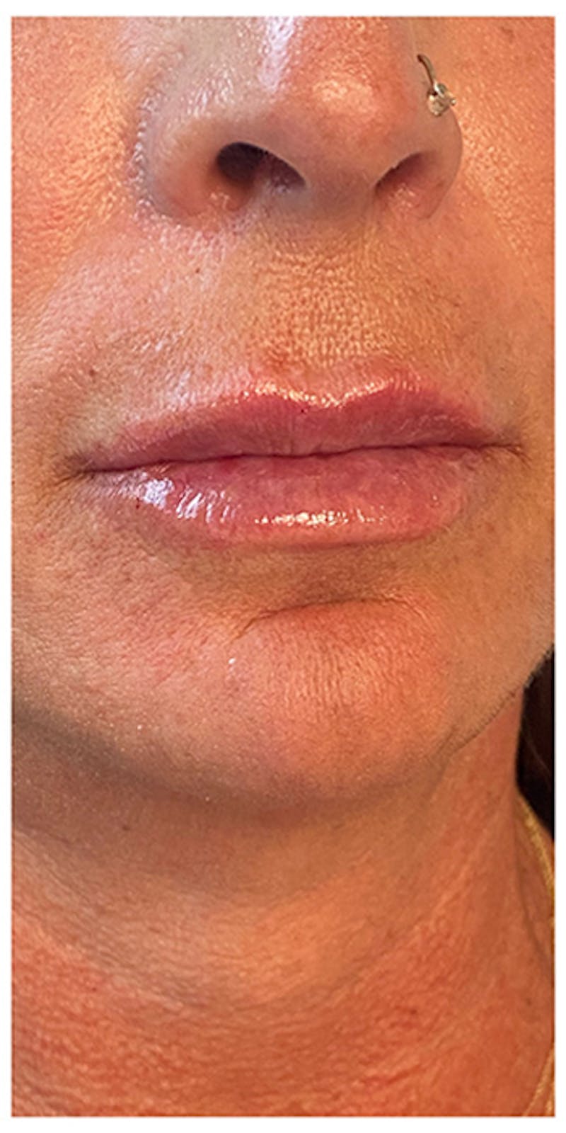 Lip Enhancement Before & After Gallery - Patient 133024185 - Image 4