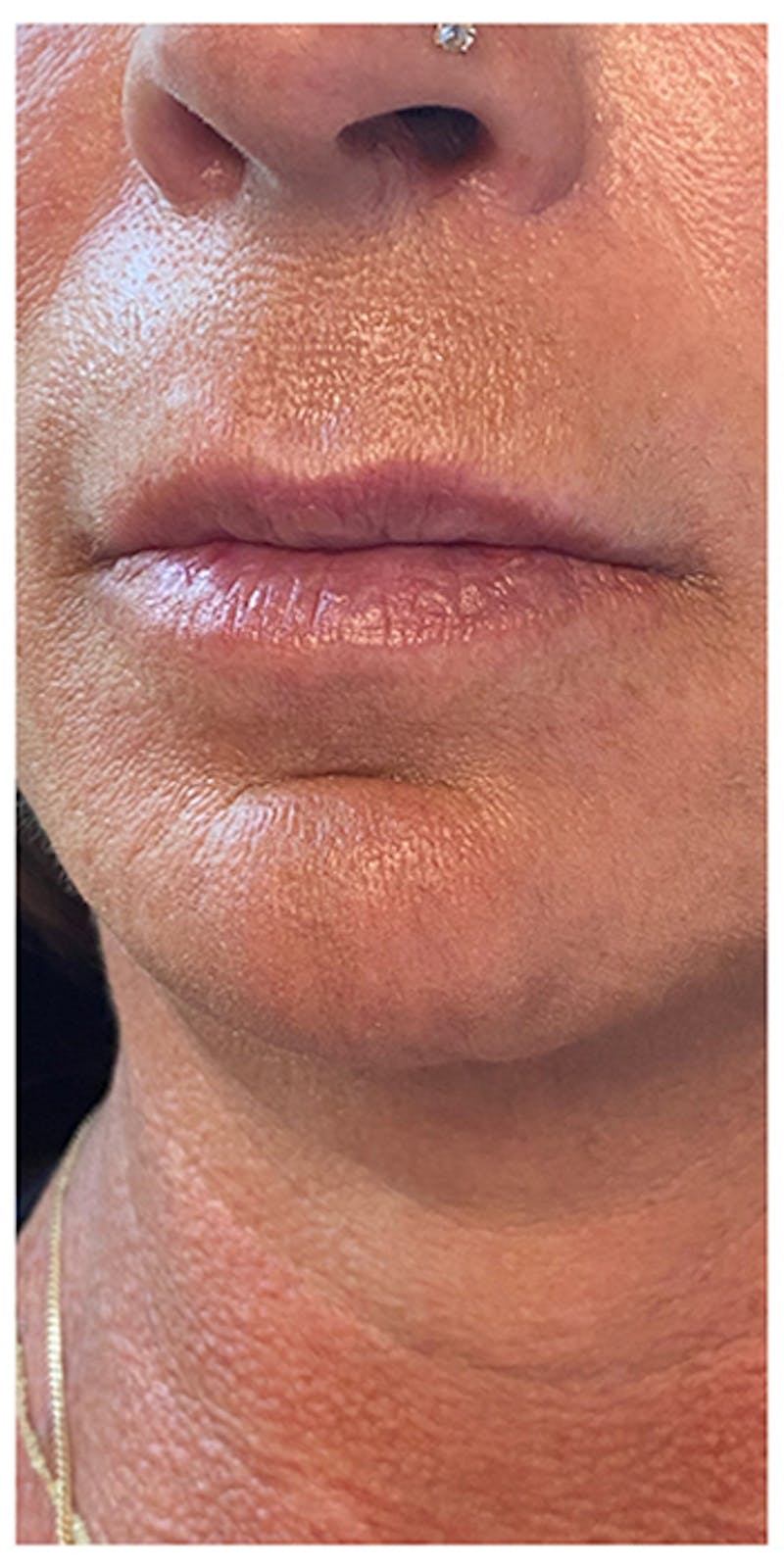Lip Enhancement Before & After Gallery - Patient 133024185 - Image 5