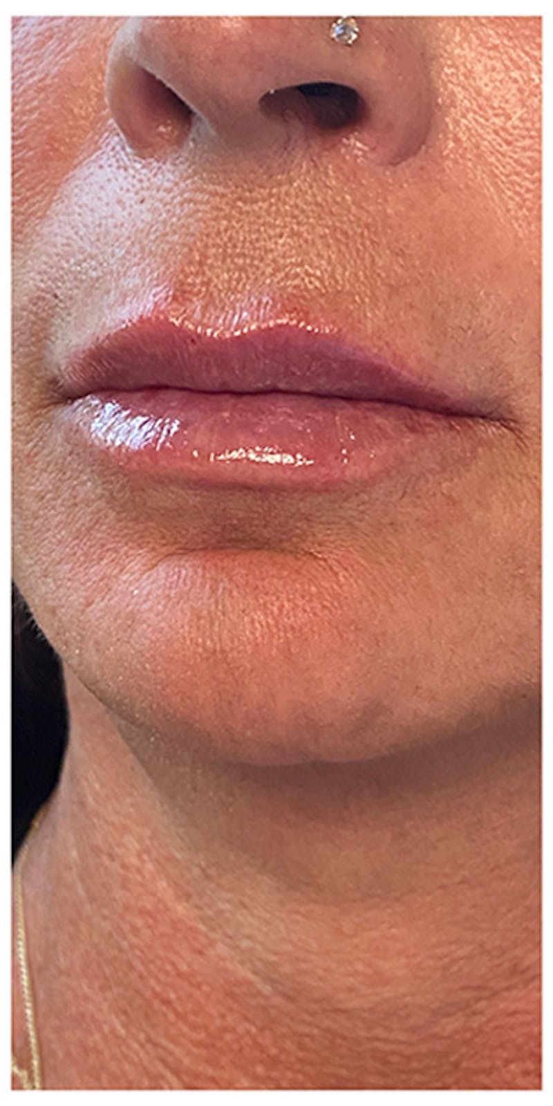 Lip Enhancement Before & After Gallery - Patient 133024185 - Image 6