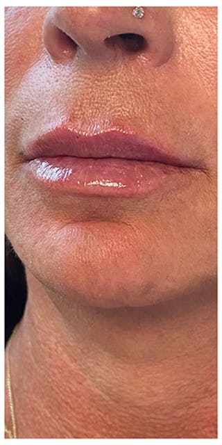 Lip Enhancement Before & After Gallery - Patient 133024185 - Image 6
