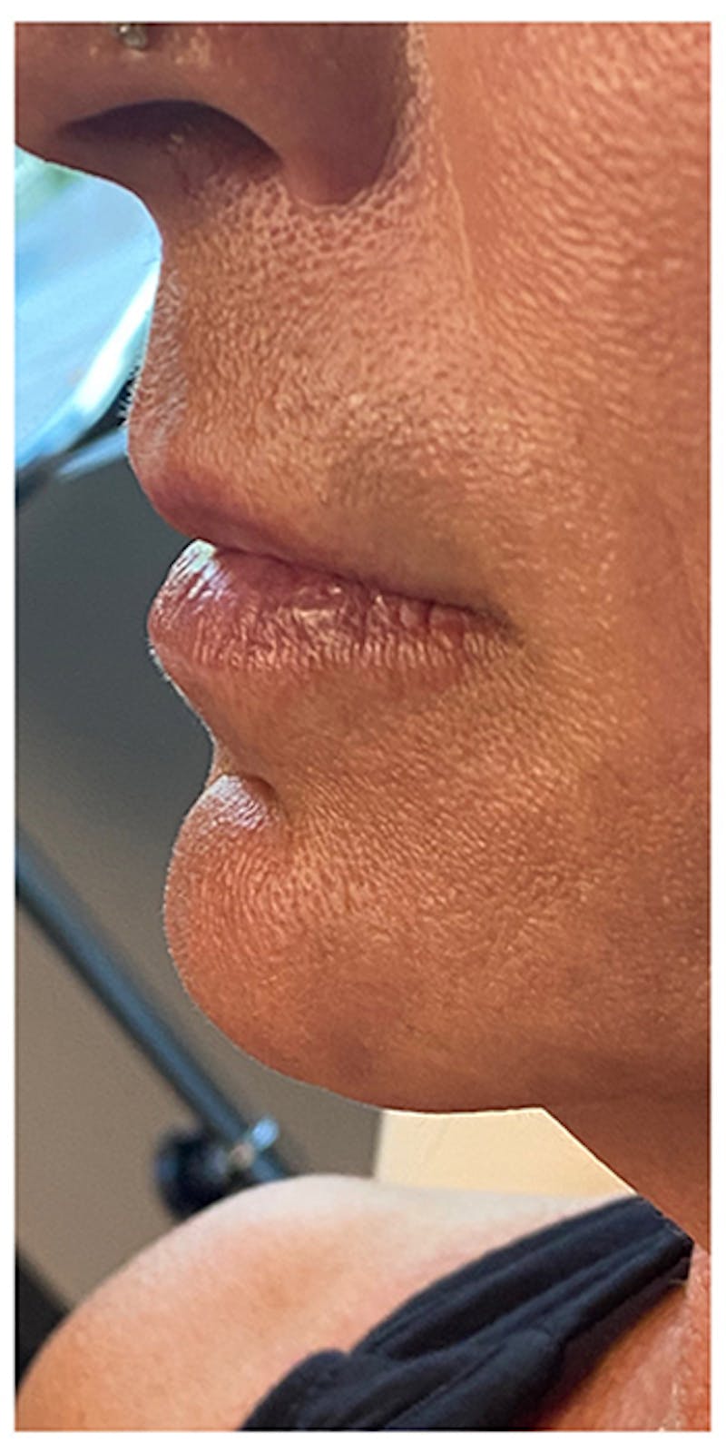 Lip Enhancement Before & After Gallery - Patient 133024185 - Image 7