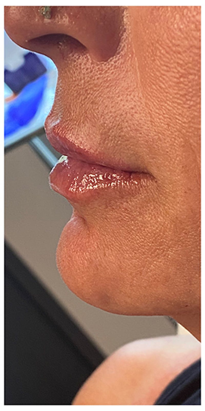 Lip Enhancement Before & After Gallery - Patient 133024185 - Image 8